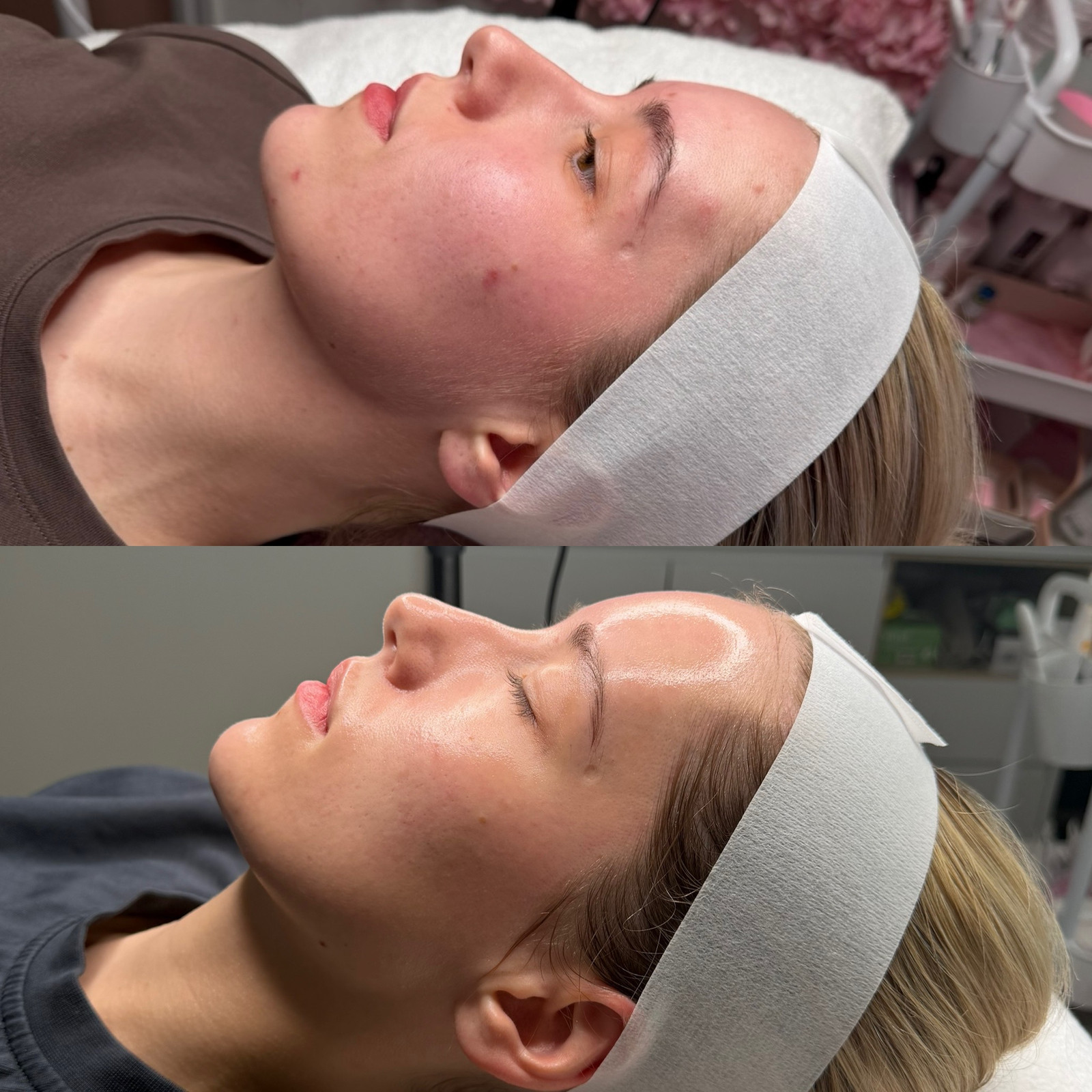 Treatment: High Frequency & LED
