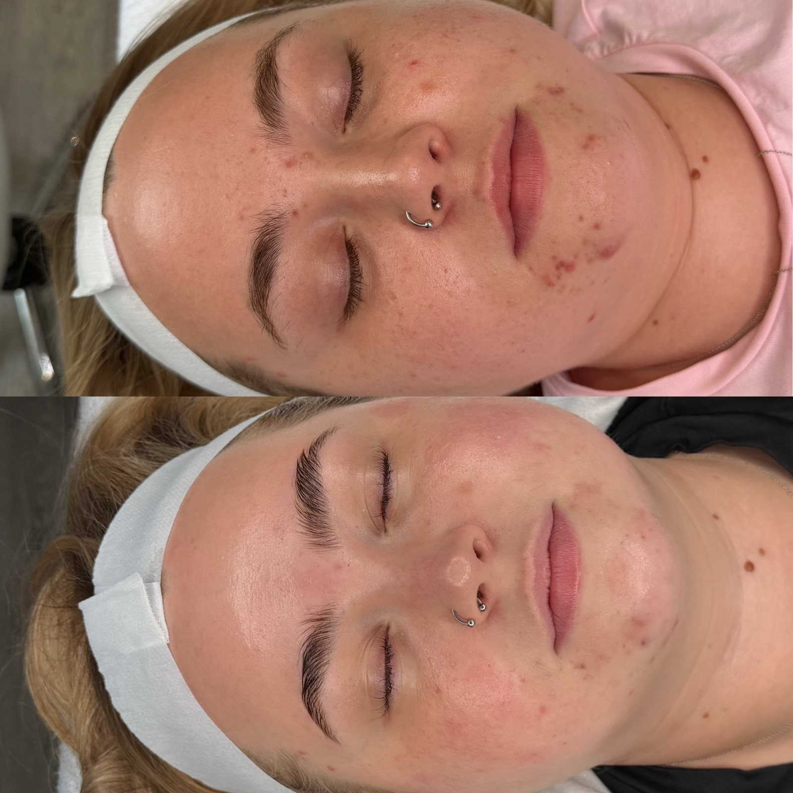 Treatment: BioRePeel & LED