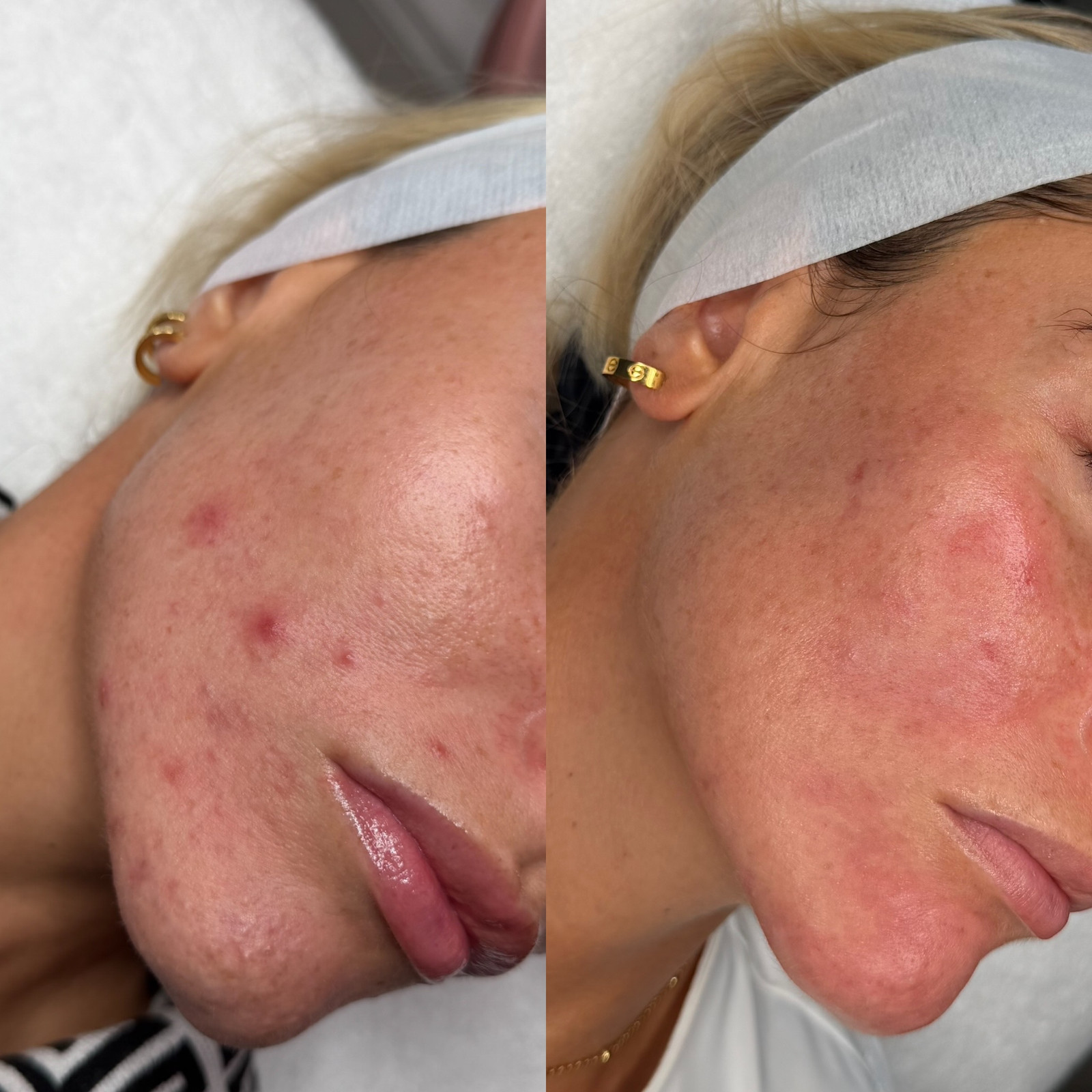 Treatment: Chemical Peel