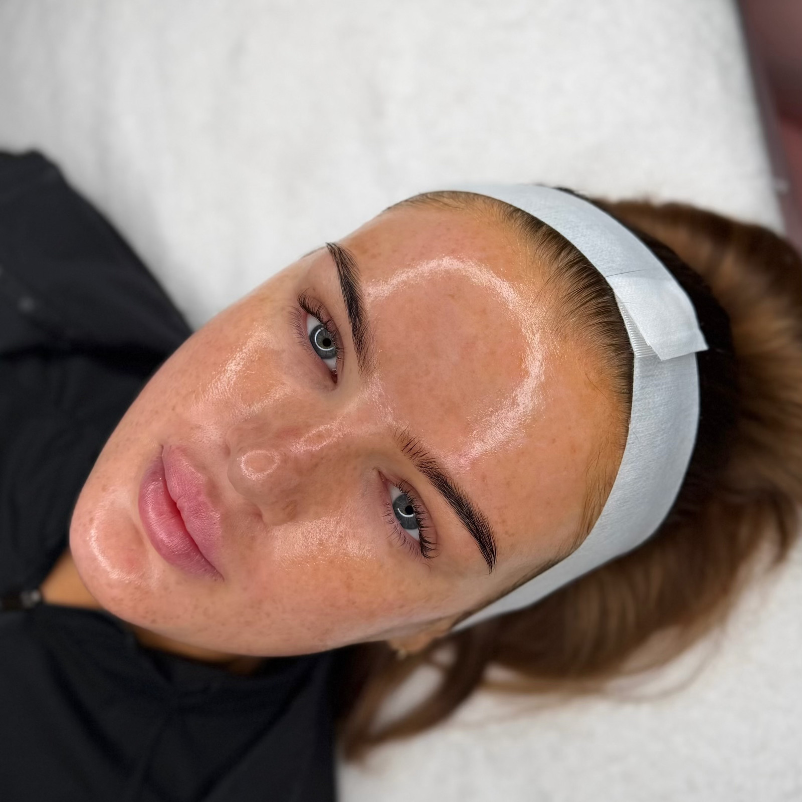 Treatment: BioRePeel & Dermaplaning