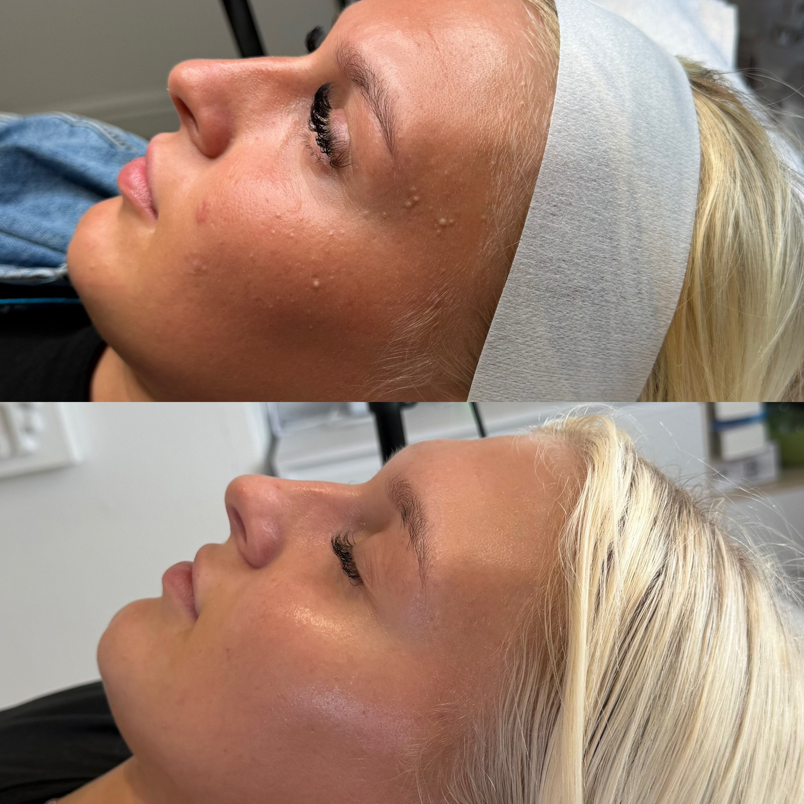 Treatment: High Frequency & LED